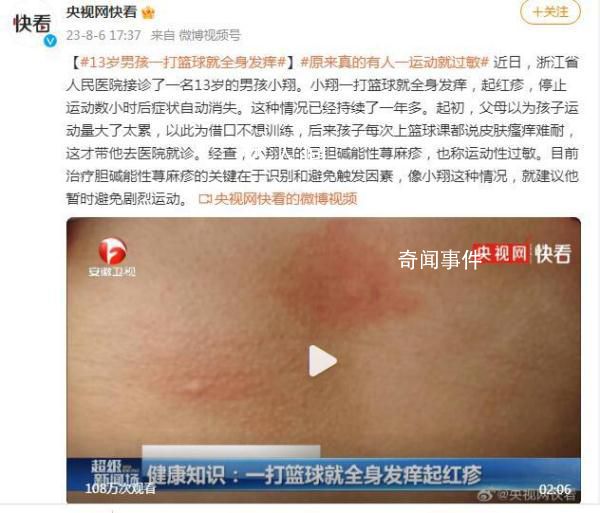 13岁男孩一打篮球就全身发痒 这种情况已经持续了一年多