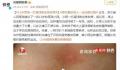 13岁男孩一打篮球就全身发痒 这种情况已经持续了一年多