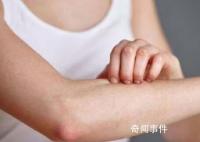 过敏多发 “元凶”就在身边 低龄患者明显增多