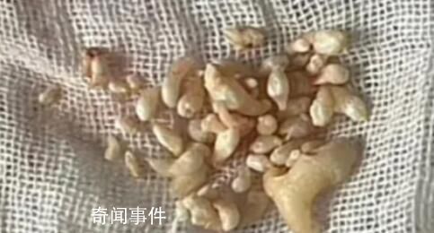 拔掉57颗牙是什么体验 牙瘤是什么病严重吗