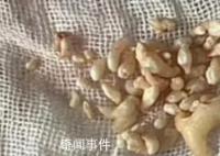 拔掉57颗牙是什么体验 牙瘤是什么病严重吗