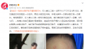 母亲为保护孩子遭到殴打 正全方位取证