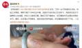 女子戴玉镯10年关节变形成手铐 玉镯始终无法通过手腕处关节