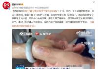 女子戴玉镯10年关节变形成手铐 玉镯始终无法通过手腕处关节