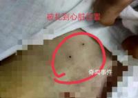 医院回应穿刺失误致女童死亡 正在走司法途径
