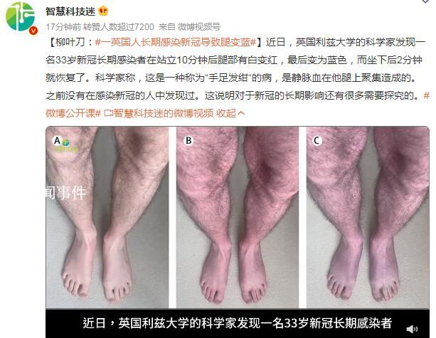 一英国人长期感染新冠导致腿变蓝 坐下后2分钟就恢复了