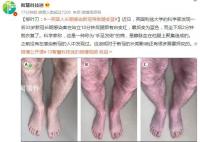一英国人长期感染新冠导致腿变蓝 坐下后2分钟就恢复了