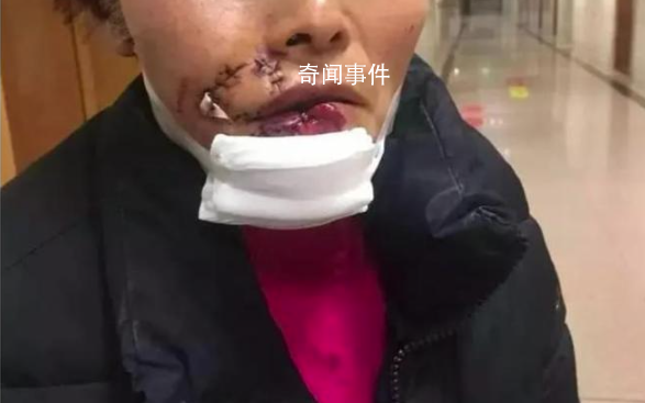 女子被狗撕碎左脸缝了500多针
