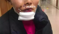 女子被狗撕碎左脸缝了500多针