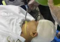 被老师打伤女孩头部水肿有感染风险 引发了网友们的关注