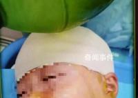 被打破头骨女生已清醒?家属回应