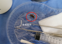 男子半夜卧床玩手机蟑螂钻进耳朵 传来一阵剧烈的疼痛