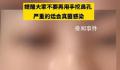 女生称因爱抠鼻子致鼻内长多团真菌 ：希望大家不要再挖鼻孔