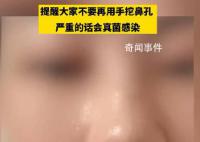 女生称因爱抠鼻子致鼻内长多团真菌 ：希望大家不要再挖鼻孔