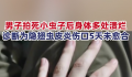男子拍死隐翅虫多处溃烂5天未愈 目前伤口仍未愈合
