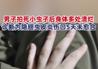 男子拍死隐翅虫多处溃烂5天未愈 目前伤口仍未愈合