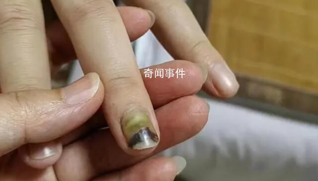 19岁女子被骗缅甸获救时遍体鳞伤 目前正接受身体以及精神方面的治疗
