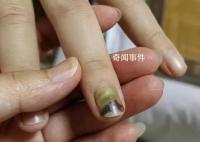 19岁女子被骗缅甸获救时遍体鳞伤 目前正接受身体以及精神方面的治疗