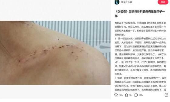 胡歌被曝拍伪装者时砸断女主锁骨 因为要拍戏只能进行手术打了七颗钢钉