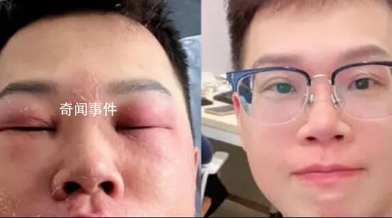 小伙称因长期抠鼻子感染丹毒 面部还有些红印在做光疗