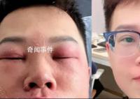 小伙称因长期抠鼻子感染丹毒 面部还有些红印在做光疗