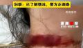 女子称孕期遭家暴被丈夫拿刀割脖子 目前警方正在调查处理