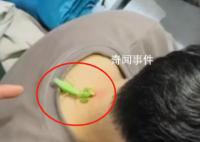 螳螂“大夫”为男子医治脖后瘊子