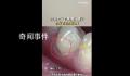27岁女子长期横向刷牙致牙齿缺损