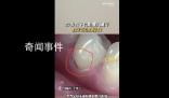 27岁女子长期横向刷牙致牙齿缺损
