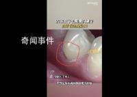27岁女子长期横向刷牙致牙齿缺损