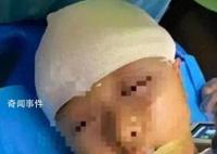 被打破头骨女孩已出院 或有后遗症