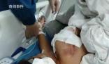男童遭阿拉斯加犬咬伤 仍在ICU救治