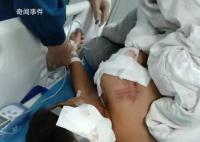 男童遭阿拉斯加犬咬伤 仍在ICU救治