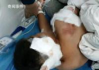 被狗咬伤男童已出ICU:耳朵缺一块