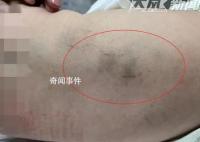 育婴师拍打婴儿被拘15天 警方调查中