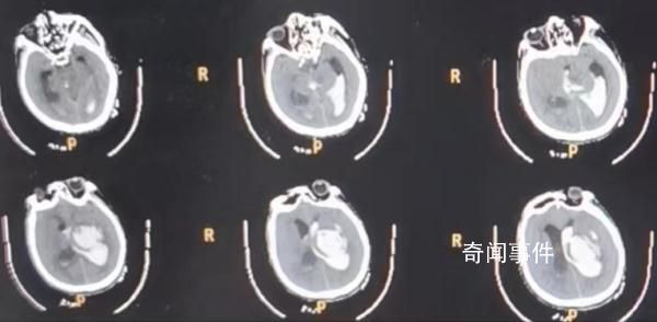 男子喂猪时晕倒 遭家猪啃食下半身