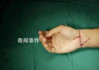 29岁小伙手腕被切断医生通宵缝合