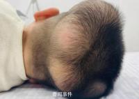 5岁男童患“超级罕见病” 国内此前仅报道过1例