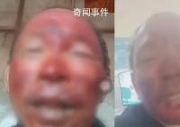 女婿去世女儿住院 男子烧伤不舍就医