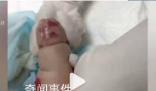 婴儿遇输液渗水起大片红肿水泡 目前医院正在积极处理