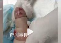 婴儿遇输液渗水起大片红肿水泡 目前医院正在积极处理