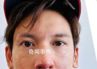 港星关智斌面部手部二级烧伤 面部和嘴唇变得红肿
