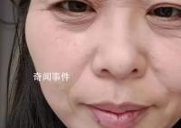 断崖式衰老女子本以为能漂亮过余生 引发网友热议