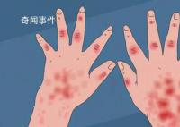 21岁男子发烧后被诊断为红斑狼疮 出现症状应及时就医