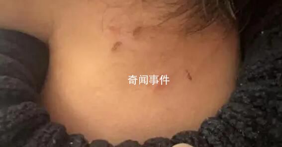 家长称孩子遭老师虐待 身上都是抠痕