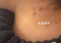 家长称孩子遭老师虐待 身上都是抠痕