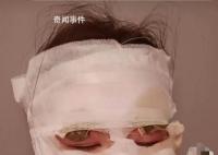 新娘结婚当天被喷雾彩带烫伤