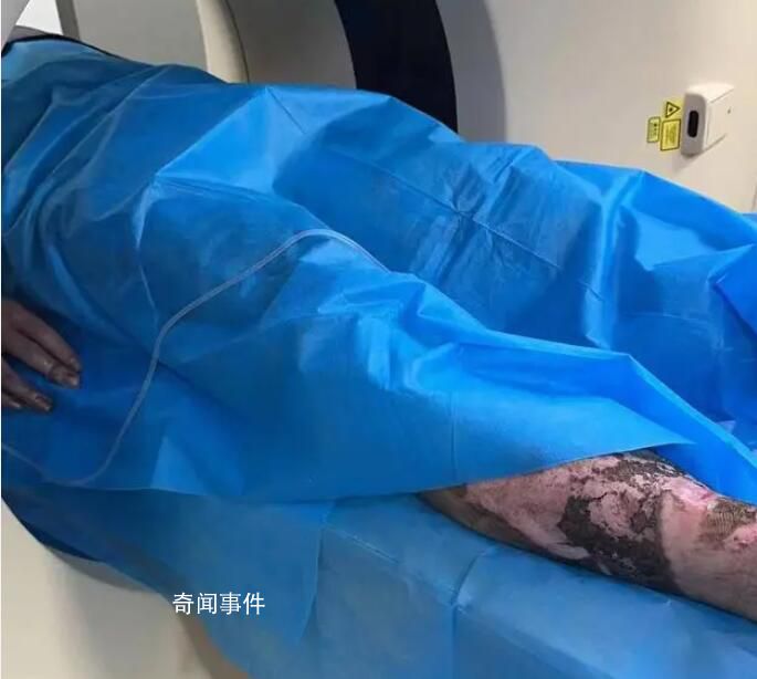 大学生爬火车拍照被烧伤进ICU 全身50%烧伤